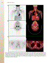 Patient Preparation and Performance of PET CT Scans in Pediatric Patients