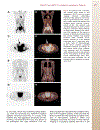 Patient Preparation and Performance of PET CT Scans in Pediatric Patients