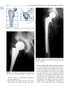 Osteoporosis Diagnosis