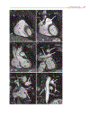 Cardiovascular MRI in Congenital Heart Disease