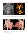 Cardiovascular MRI in Congenital Heart Disease