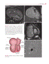 Cardiovascular MRI in Congenital Heart Disease