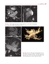 Cardiovascular MRI in Congenital Heart Disease