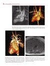 Cardiovascular MRI in Congenital Heart Disease