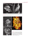 Cardiovascular MRI in Congenital Heart Disease