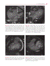 Cardiovascular MRI in Congenital Heart Disease