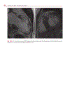 Cardiovascular MRI in Congenital Heart Disease