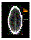 CT Scan trong tai biến mạch máu não