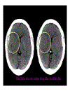 CT Scan trong tai biến mạch máu não