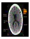 CT Scan trong tai biến mạch máu não