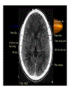 CT Scan trong tai biến mạch máu não