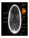 CT Scan trong tai biến mạch máu não