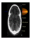 CT Scan trong tai biến mạch máu não