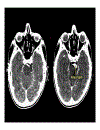 CT Scan trong tai biến mạch máu não