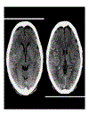 CT Scan trong tai biến mạch máu não