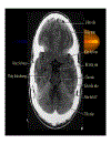 CT Scan trong tai biến mạch máu não