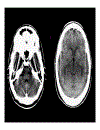 CT Scan trong tai biến mạch máu não