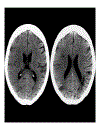 CT Scan trong tai biến mạch máu não