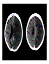 CT Scan trong tai biến mạch máu não