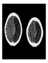 CT Scan trong tai biến mạch máu não