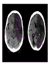 CT Scan trong tai biến mạch máu não