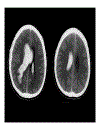 CT Scan trong tai biến mạch máu não