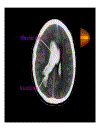 CT Scan trong tai biến mạch máu não