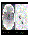 CT Scan trong tai biến mạch máu não