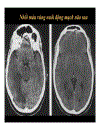 CT Scan trong tai biến mạch máu não