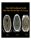 CT Scan trong tai biến mạch máu não