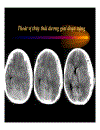 CT Scan trong tai biến mạch máu não