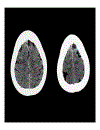 CT Scan trong tai biến mạch máu não