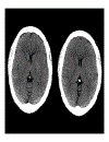 CT Scan trong tai biến mạch máu não