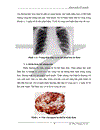 Nghiên cứu biểu hiện gen mã hóa kháng nguyên bảo vệ PA của vi khuẩn Bacillus anthracis