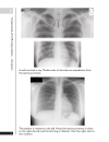 A Z of Chest Radiology