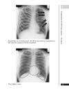 A Z of Chest Radiology