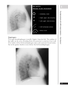 A Z of Chest Radiology