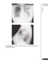 A Z of Chest Radiology