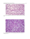 Underlying Mechanisms of Epilepsy