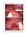 Ulcerative Colitis Treatments Special Populations and the Future