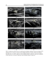 Recent Advances in the Pathogenesis Prevention and Management of Type 2 Diabetes and its Complications