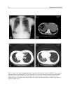 Approaches to Bronchitis