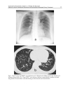 Approaches to Bronchitis