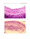 Approaches to Bronchitis