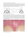 Gingival Diseases Their Aetiology Prevention and Treatment