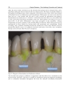 Gingival Diseases Their Aetiology Prevention and Treatment