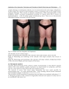 Advanced Techniques in Liposuction and Fat Transfer