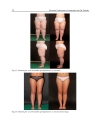 Advanced Techniques in Liposuction and Fat Transfer