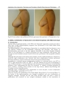 Advanced Techniques in Liposuction and Fat Transfer