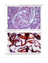 An Update on Glomerulopathies Clinical and Treatment Aspects